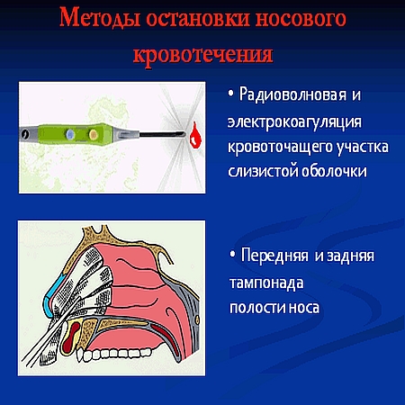 Прижигание В Носу Лазером Стоимость Операции